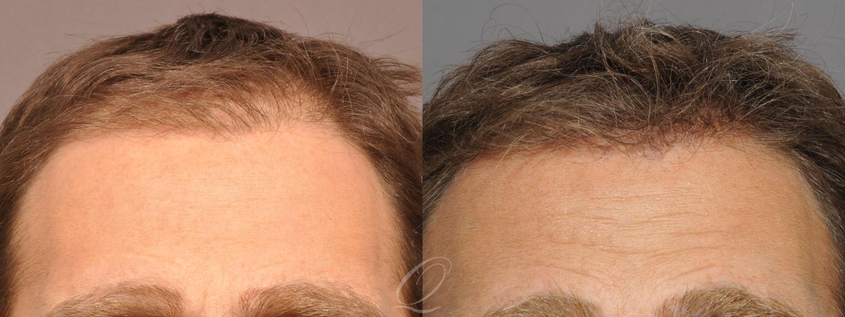 FUT Case 1042 Before & After View #1 | Rochester, Buffalo, & Syracuse, NY | Quatela Center for Hair Restoration