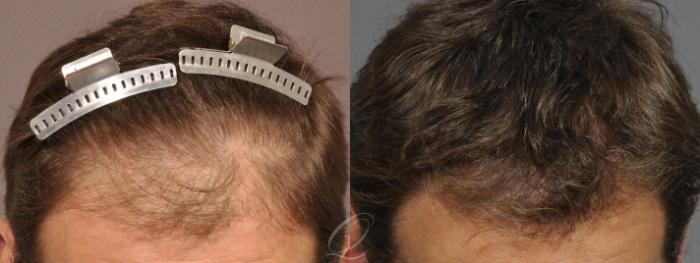 Before & After Male Hairline and Central Density Hair Restoration Case 1042 View #2 View in Rochester, Buffalo, & Syracuse, NY