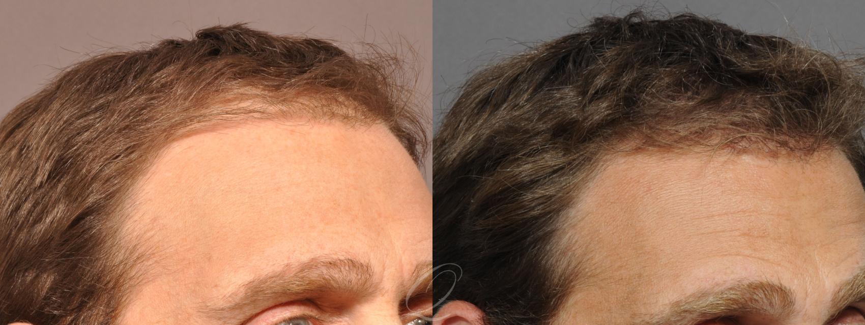 FUT Case 1042 Before & After View #3 | Rochester, Buffalo, & Syracuse, NY | Quatela Center for Hair Restoration