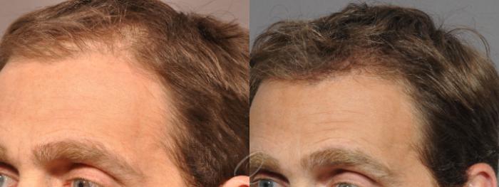 Before & After Male Hairline and Central Density Hair Restoration Case 1042 View #4 View in Rochester, Buffalo, & Syracuse, NY