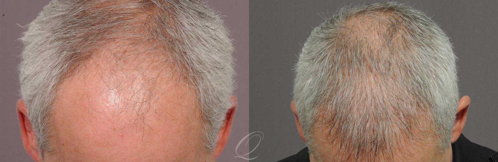 Male Hairline and Central Density Hair Restoration Case 1043 Before & After View #1 | Serving Rochester, Syracuse & Buffalo, NY | Quatela Center for Plastic Surgery