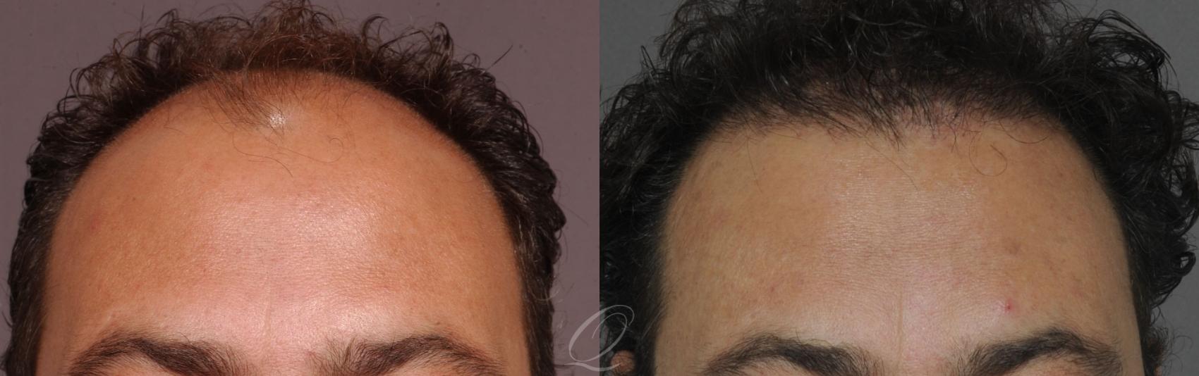 Male Hairline and Central Density Hair Restoration Case 1044 Before & After View #1 | Rochester, Buffalo, & Syracuse, NY | Quatela Center for Hair Restoration