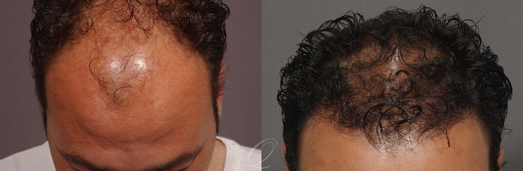 FUT Case 1044 Before & After View #2 | Rochester, NY | Quatela Center for Hair Restoration