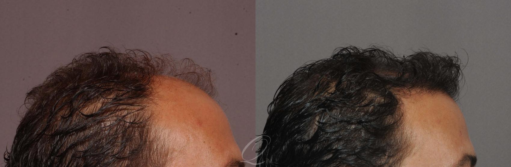 FUT Case 1044 Before & After View #3 | Rochester, NY | Quatela Center for Hair Restoration