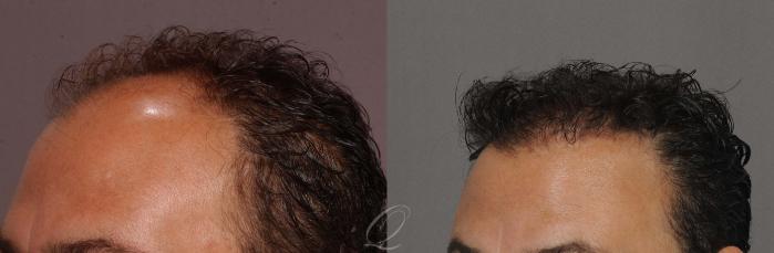 Male Hairline and Central Density Hair Restoration Case 1044 Before & After View #4 | Serving Rochester, Syracuse & Buffalo, NY | Quatela Center for Plastic Surgery