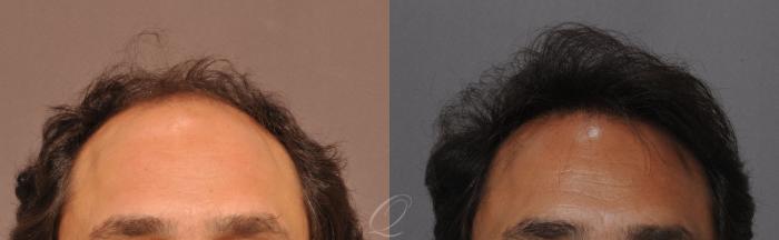 Male Hairline and Central Density Hair Restoration Case 1045 Before & After View #1 | Serving Rochester, Syracuse & Buffalo, NY | Quatela Center for Plastic Surgery