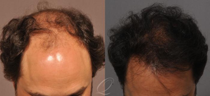 Before & After Male Hairline and Central Density Hair Restoration Case 1045 View #2 View in Rochester, Buffalo, & Syracuse, NY