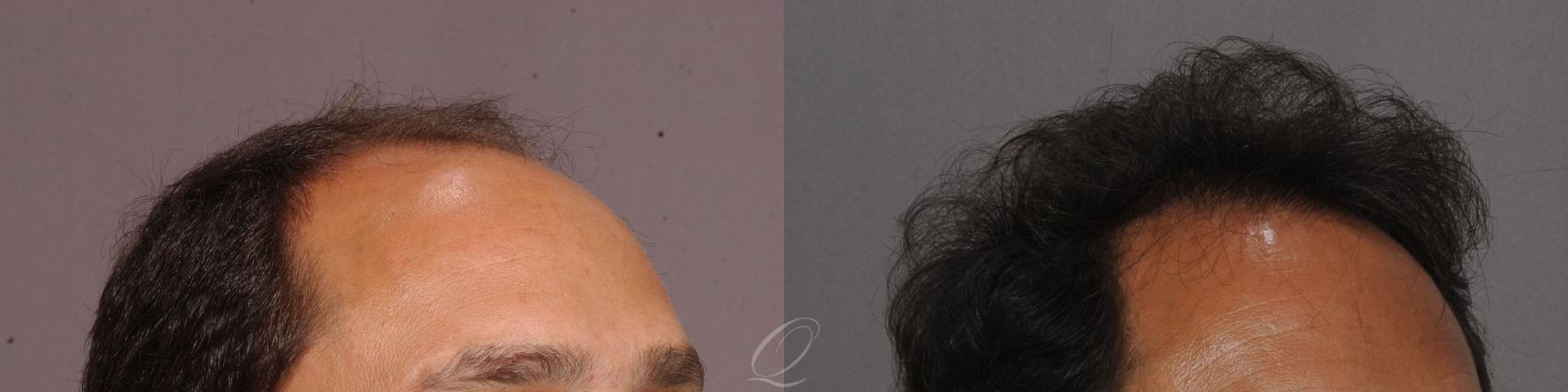 FUT Case 1045 Before & After View #3 | Rochester, NY | Quatela Center for Hair Restoration