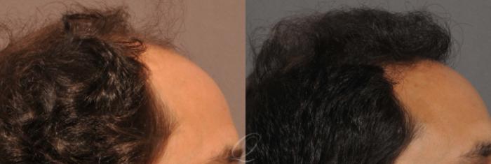 Before & After Male Hairline and Central Density Hair Restoration Case 1045 View #4 View in Rochester, Buffalo, & Syracuse, NY
