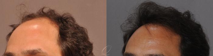 Male Hairline and Central Density Hair Restoration Case 1045 Before & After View #5 | Serving Rochester, Syracuse & Buffalo, NY | Quatela Center for Plastic Surgery