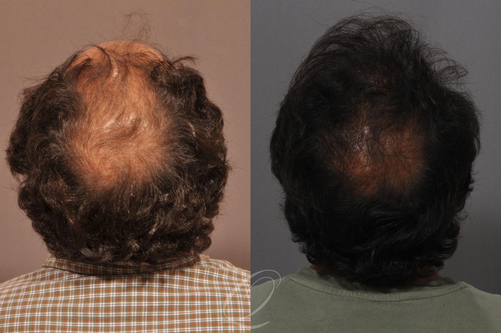 FUT Case 1045 Before & After View #6 | Rochester, NY | Quatela Center for Hair Restoration