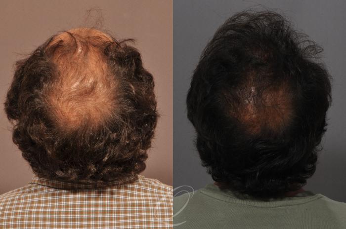 Before & After Male Hairline and Central Density Hair Restoration Case 1045 View #6 View in Rochester, Buffalo, & Syracuse, NY