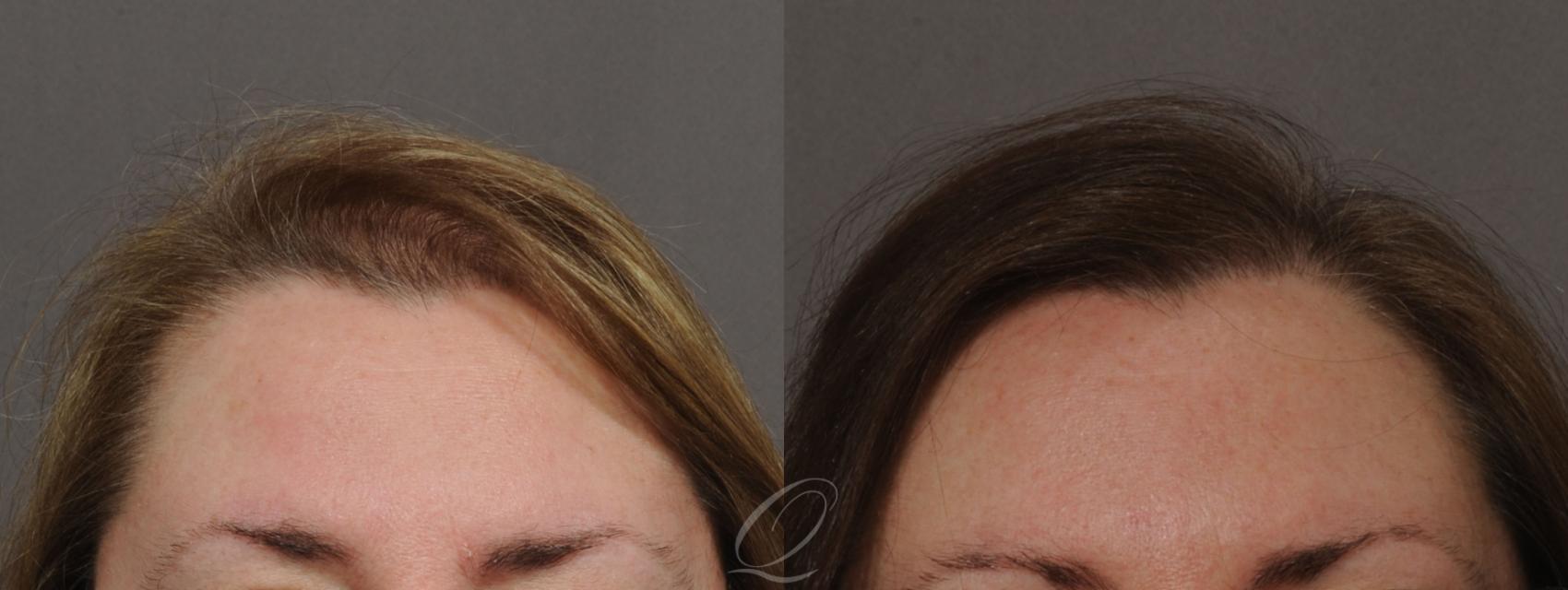 Female FUT Hair Transplant Case 1046 Before & After View #1 | Serving Rochester, Syracuse & Buffalo, NY | Quatela Center for Plastic Surgery