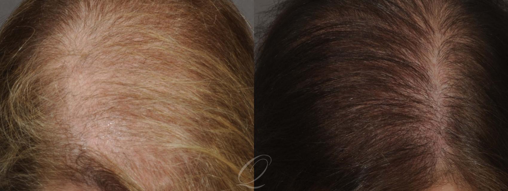 FUT Case 1046 Before & After View #2 | Rochester, Buffalo, & Syracuse, NY | Quatela Center for Hair Restoration