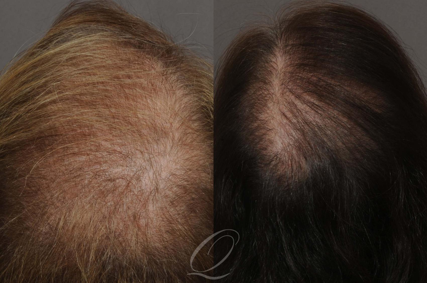 Female FUT Hair Transplant Case 1046 Before & After View #4 | Rochester, Buffalo, & Syracuse, NY | Quatela Center for Hair Restoration