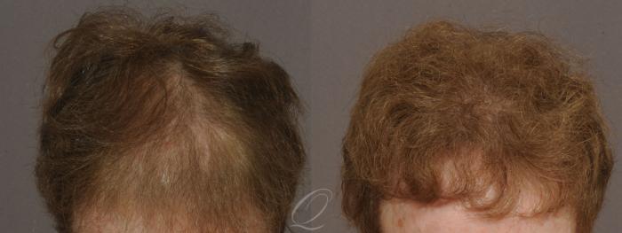Female FUT Hair Transplant Case 1047 Before & After View #1 | Rochester, Buffalo, & Syracuse, NY | Quatela Center for Hair Restoration