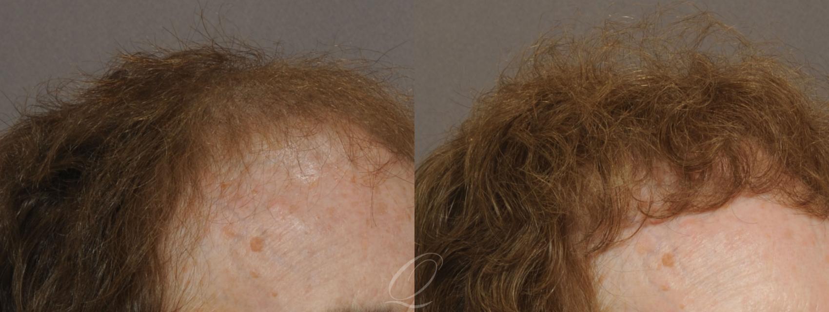 Female FUT Hair Transplant Case 1047 Before & After View #2 | Rochester, Buffalo, & Syracuse, NY | Quatela Center for Hair Restoration