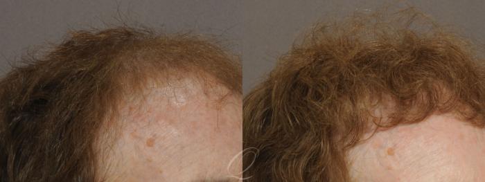 Female FUT Hair Transplant Case 1047 Before & After View #2 | Serving Rochester, Syracuse & Buffalo, NY | Quatela Center for Plastic Surgery