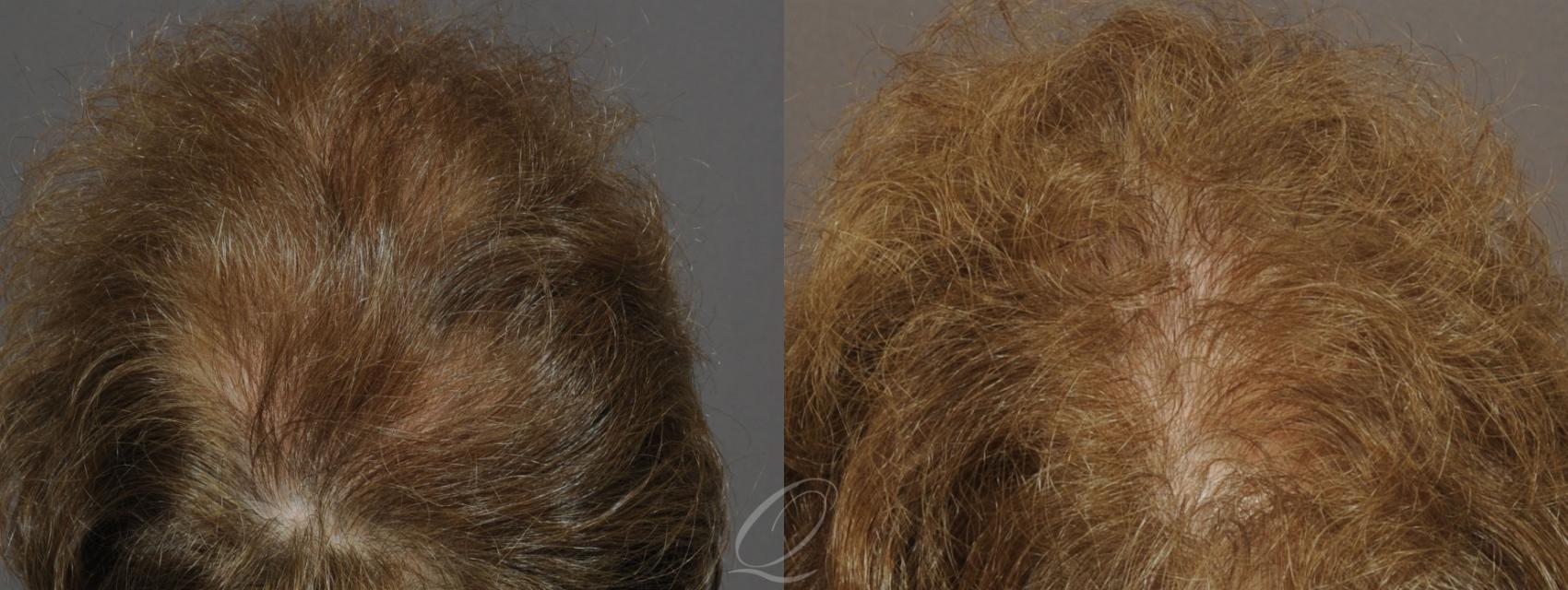 Female FUT Hair Transplant Case 1047 Before & After View #3 | Rochester, Buffalo, & Syracuse, NY | Quatela Center for Hair Restoration