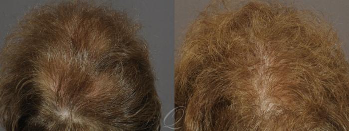 Female FUT Hair Transplant Case 1047 Before & After View #3 | Serving Rochester, Syracuse & Buffalo, NY | Quatela Center for Plastic Surgery
