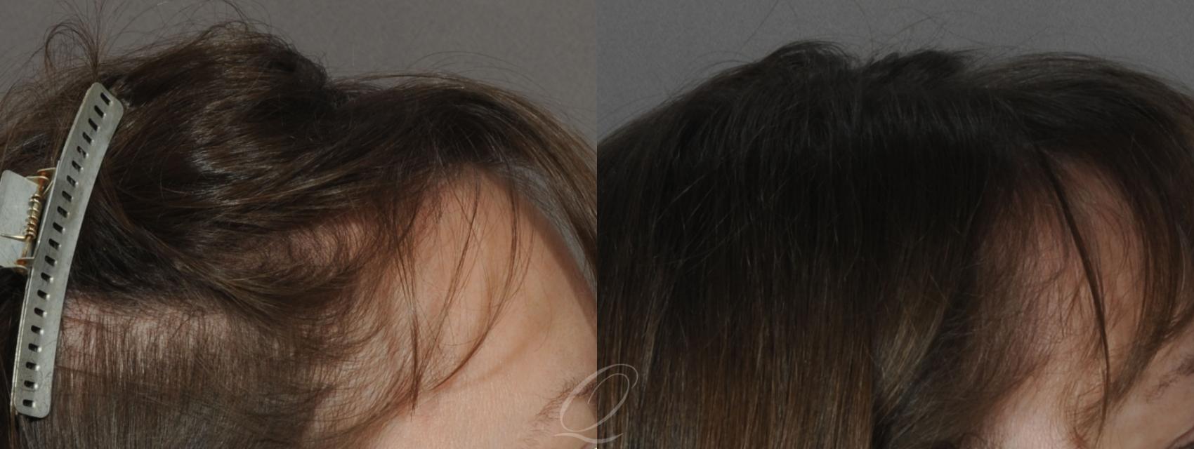 FUT Case 1048 Before & After View #1 | Serving Rochester, Syracuse & Buffalo, NY | Quatela Center for Plastic Surgery