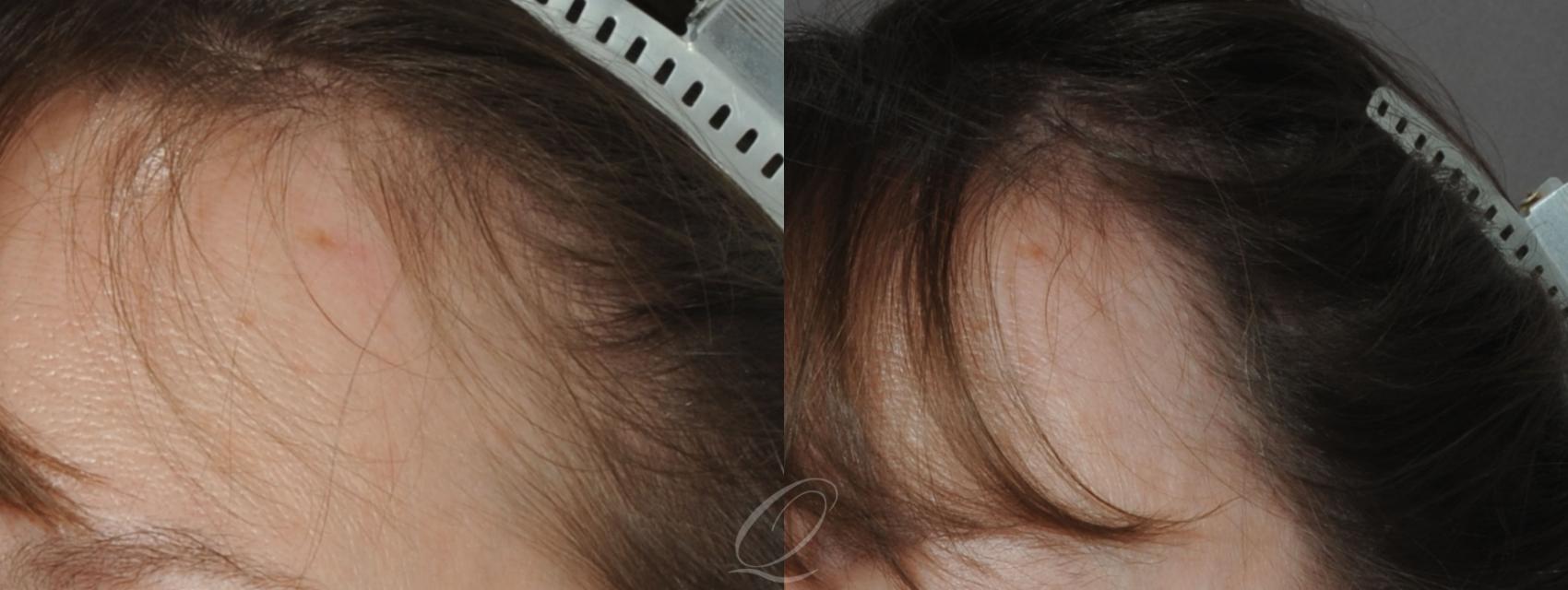 FUT Case 1048 Before & After View #3 | Rochester, NY | Quatela Center for Hair Restoration