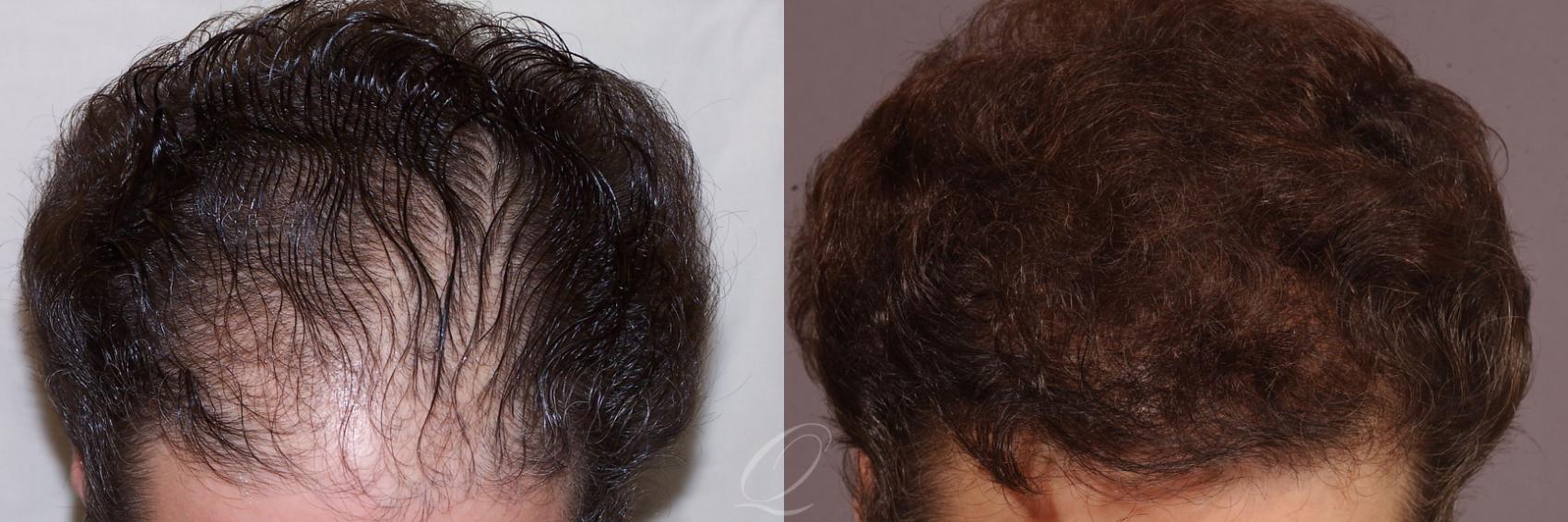 Female FUT Hair Transplant Case 1049 Before & After View #1 | Rochester, Buffalo, & Syracuse, NY | Quatela Center for Hair Restoration