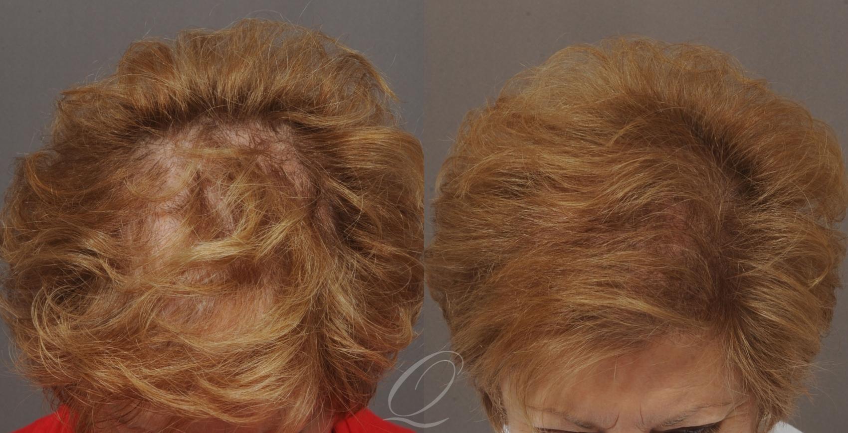 FUT Case 1053 Before & After View #1 | Rochester, Buffalo, & Syracuse, NY | Quatela Center for Hair Restoration