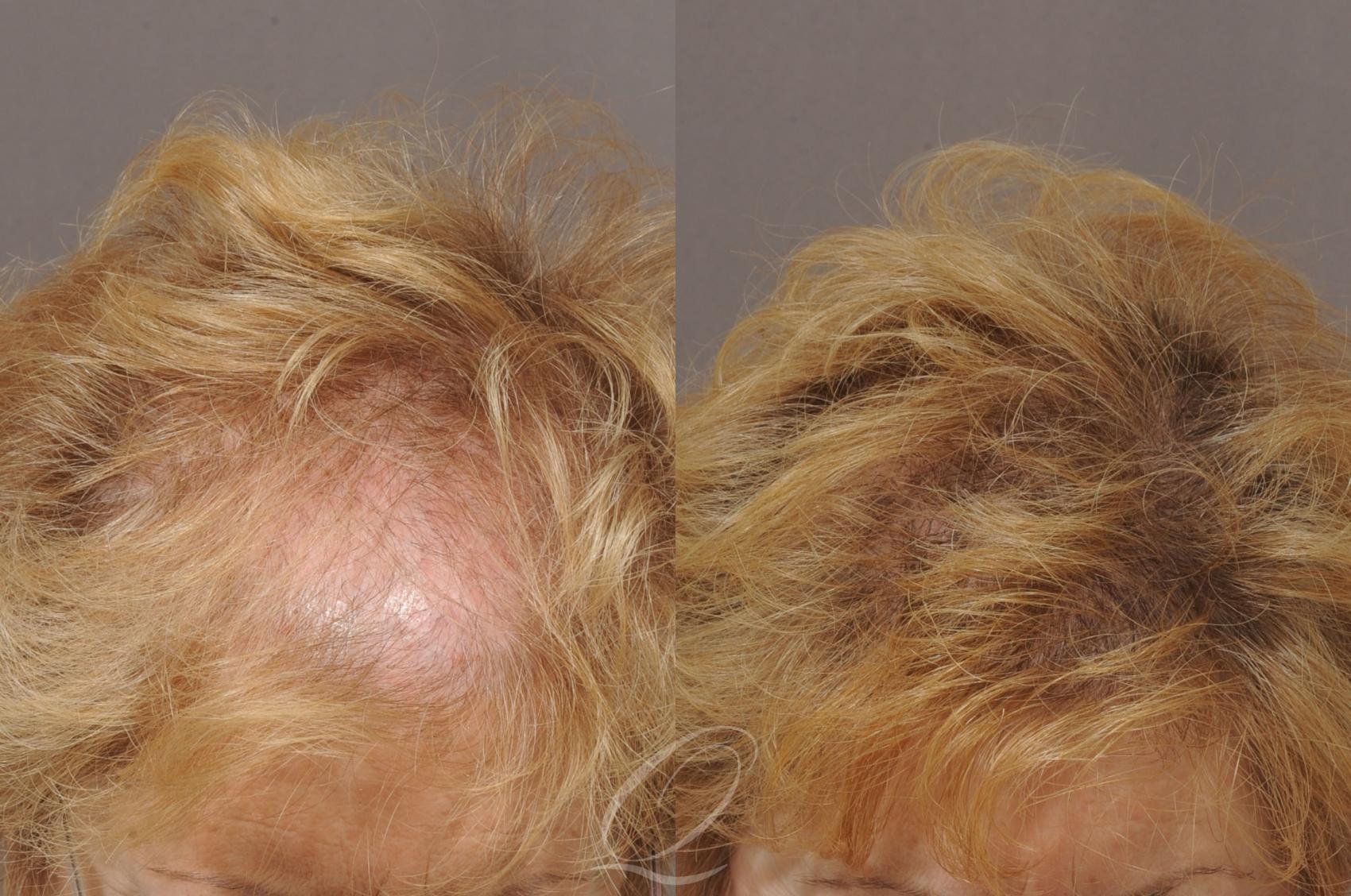 Female FUT Hair Transplant Case 1053 Before & After View #2 | Rochester, Buffalo, & Syracuse, NY | Quatela Center for Hair Restoration