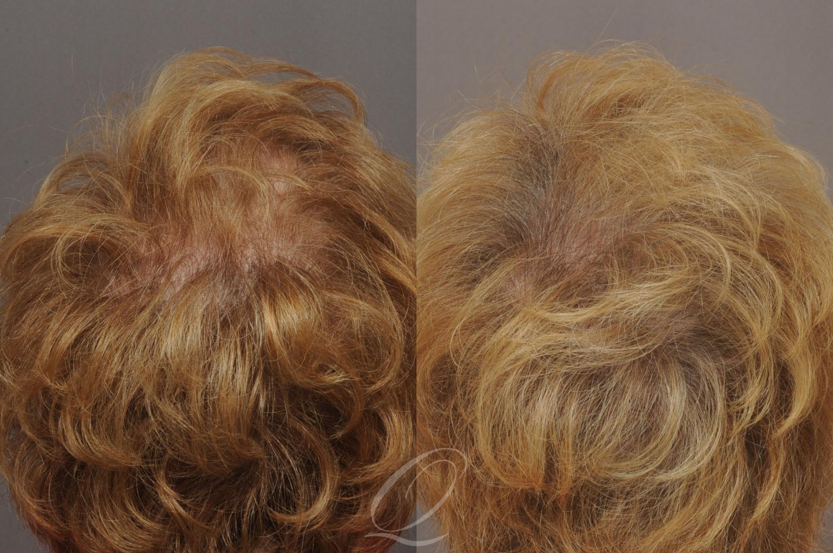 Female FUT Hair Transplant Case 1053 Before & After View #3 | Serving Rochester, Syracuse & Buffalo, NY | Quatela Center for Plastic Surgery