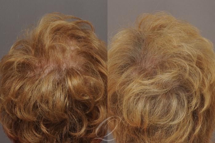 Female FUT Hair Transplant Case 1053 Before & After View #3 | Rochester, Buffalo, & Syracuse, NY | Quatela Center for Hair Restoration
