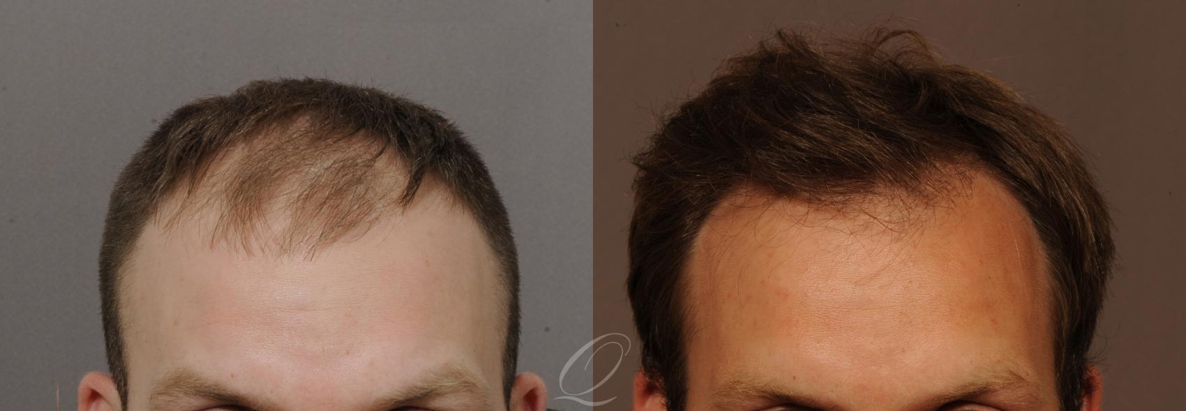 Male Hairline and Central Density Hair Restoration Case 1120 Before & After View #1 | Serving Rochester, Syracuse & Buffalo, NY | Quatela Center for Plastic Surgery