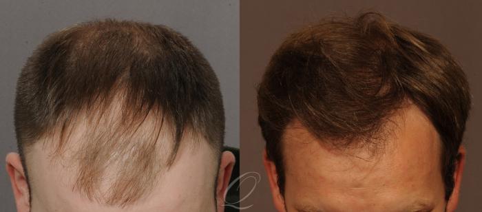 Male Hairline and Central Density Hair Restoration Case 1120 Before & After View #2 | Serving Rochester, Syracuse & Buffalo, NY | Quatela Center for Plastic Surgery