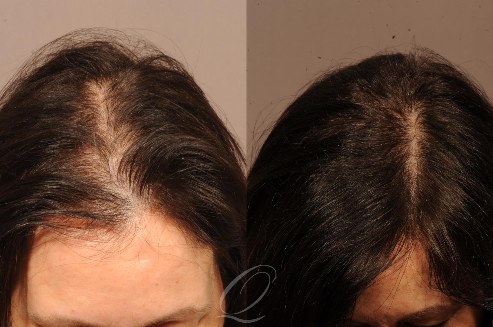 Before & After Female FUT Hair Transplant Case 1121 View #1 View in Rochester, Buffalo, & Syracuse, NY