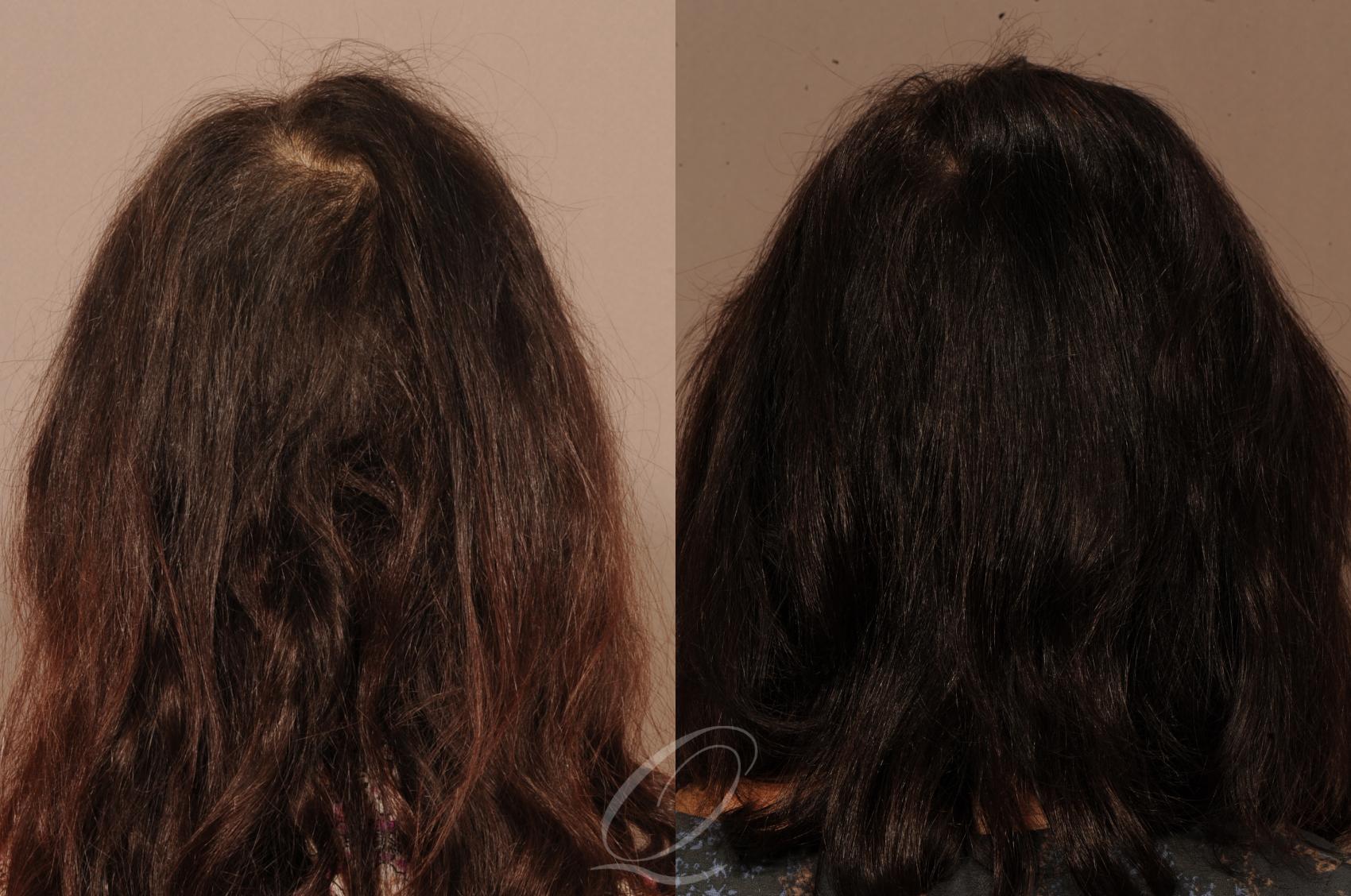 FUT Case 1121 Before & After View #2 | Rochester, NY | Quatela Center for Hair Restoration