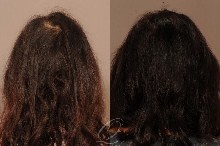 FUT Case 1121 Before & After View #2 | Rochester, Buffalo, & Syracuse, NY | Quatela Center for Hair Restoration