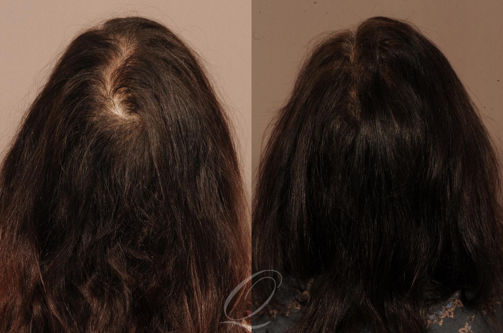 FUT Case 1121 Before & After View #3 | Rochester, NY | Quatela Center for Hair Restoration