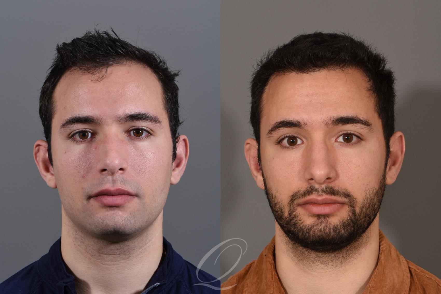 Male Hairline and Central Density Hair Restoration Case 1519 Before & After View #1 | Serving Rochester, Syracuse & Buffalo, NY | Quatela Center for Plastic Surgery