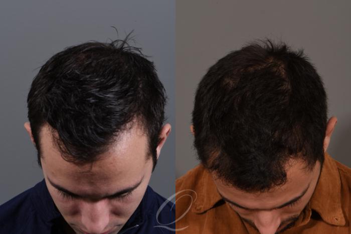 Male Hairline and Central Density Hair Restoration Case 1519 Before & After View #2 | Serving Rochester, Syracuse & Buffalo, NY | Quatela Center for Plastic Surgery