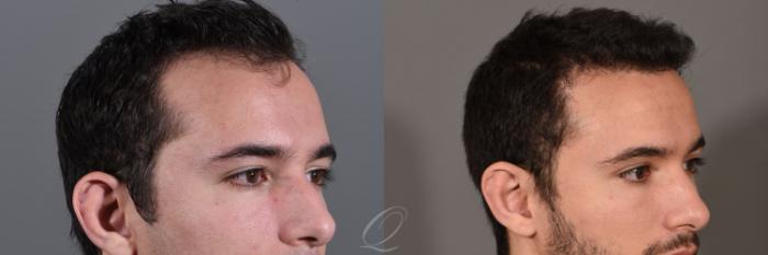 Male Hairline and Central Density Hair Restoration Case 1519 Before & After View #3 | Serving Rochester, Syracuse & Buffalo, NY | Quatela Center for Plastic Surgery