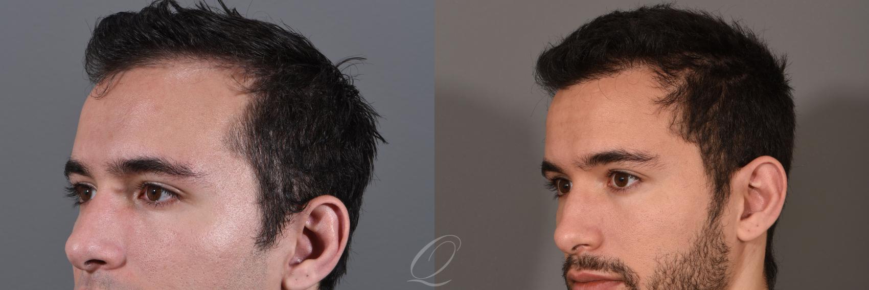 Male Hairline and Central Density Hair Restoration Case 1519 Before & After View #4 | Rochester, Buffalo, & Syracuse, NY | Quatela Center for Hair Restoration