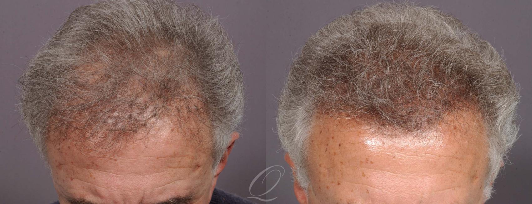 Hair Plug Repair Case 1037 Before & After View #1 | Serving Rochester, Syracuse & Buffalo, NY | Quatela Center for Plastic Surgery