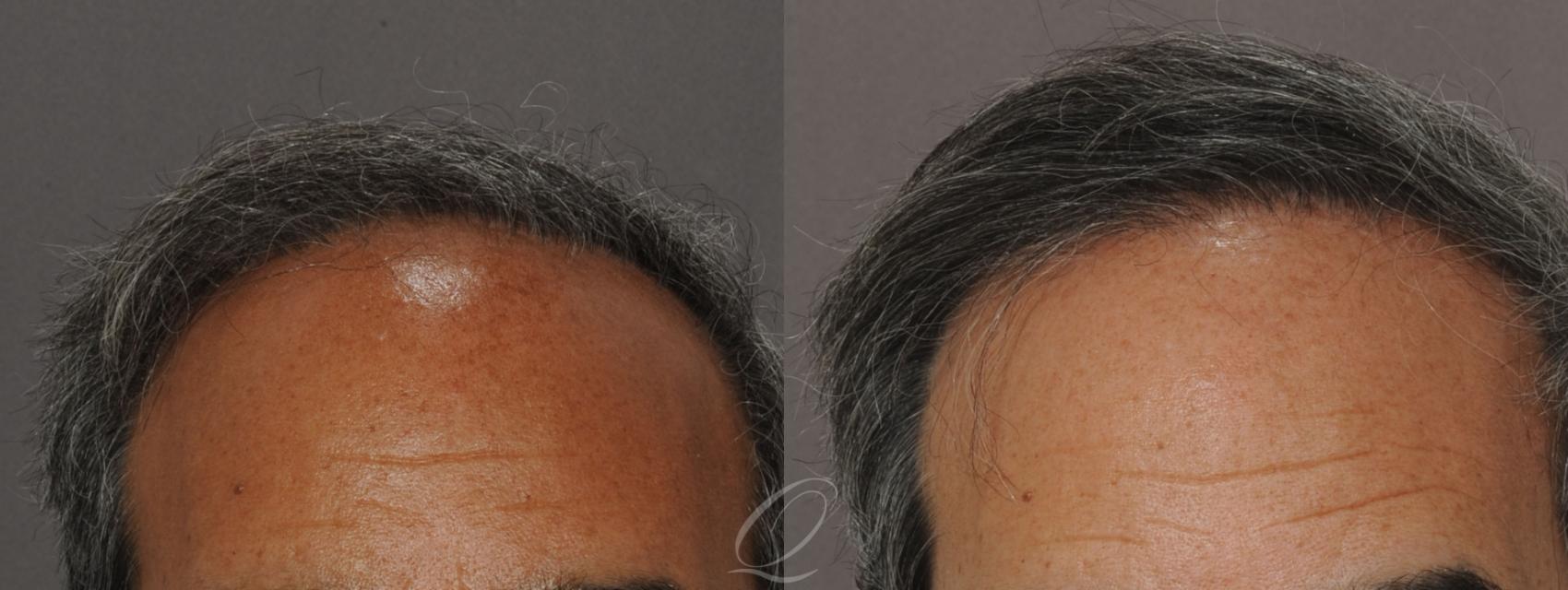 Before & After Hair Plug Repair Case 1038 View #1 View in Rochester, Buffalo, & Syracuse, NY