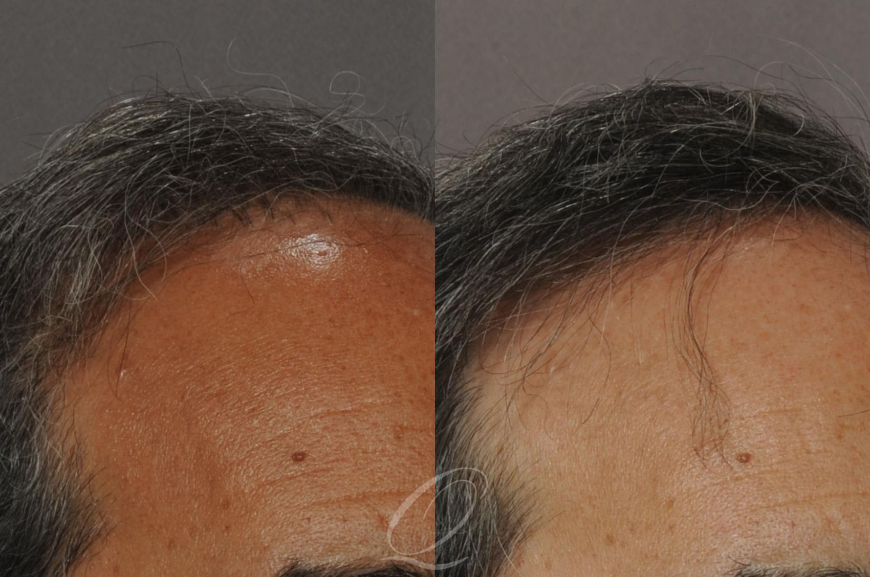 Hair Plug Repair Before & After Photos Patient 1038 | Serving Rochester,  Syracuse & Buffalo, NY | Quatela Center for Plastic Surgery