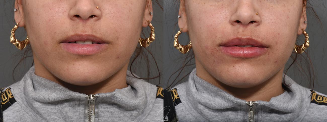 Juvederm™ Case 375 Before & After View #1 | Serving Rochester, Syracuse & Buffalo, NY | Quatela Center for Plastic Surgery