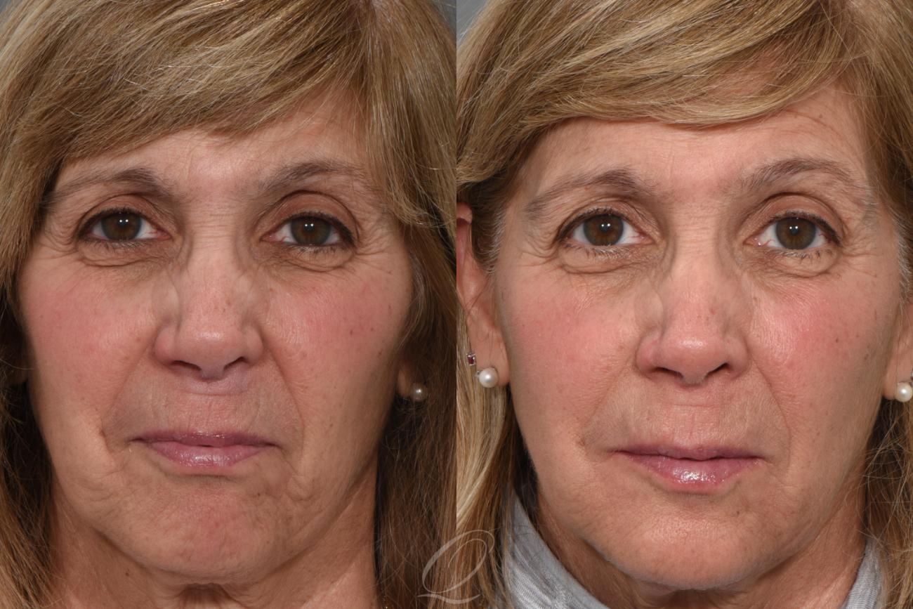 Juvederm™ Case 1530 Before & After View #1 | Serving Rochester, Syracuse & Buffalo, NY | Quatela Center for Plastic Surgery