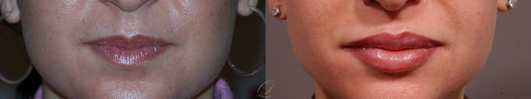 Lip Augmentation Case 227 Before & After View #1 | Serving Rochester, Syracuse & Buffalo, NY | Quatela Center for Plastic Surgery