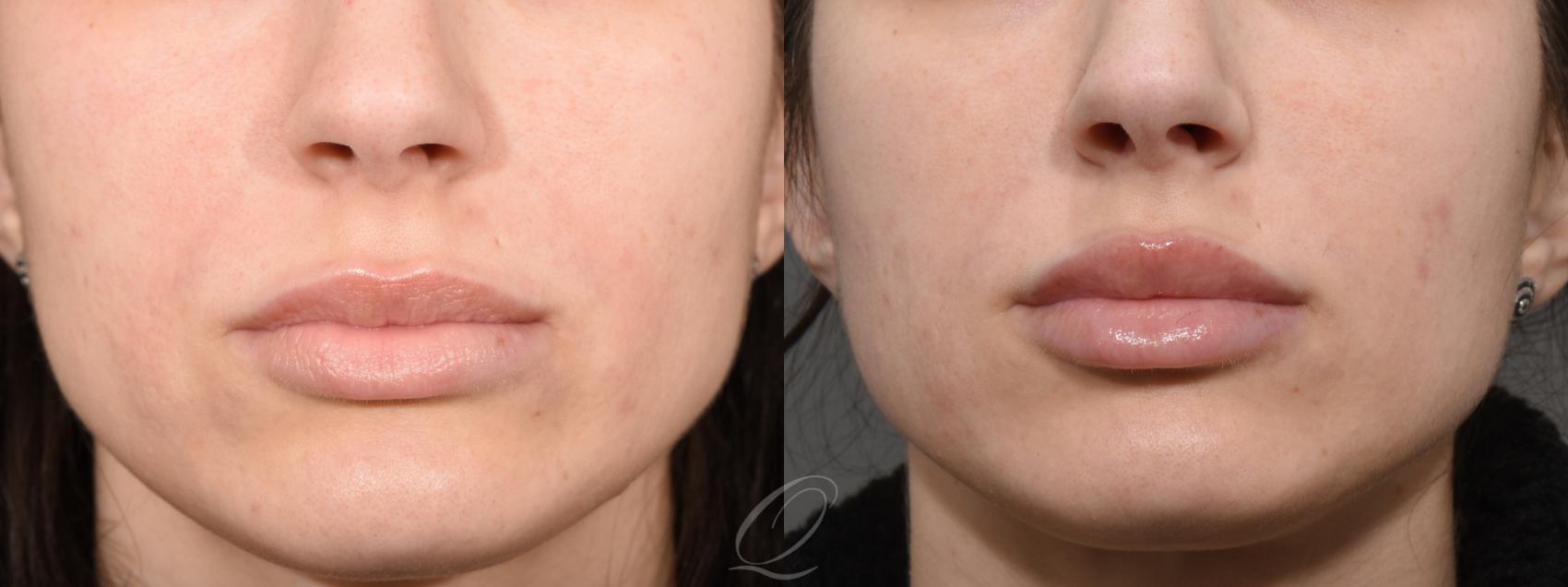 Juvederm™ Case 369 Before & After View #1 | Serving Rochester, Syracuse & Buffalo, NY | Quatela Center for Plastic Surgery