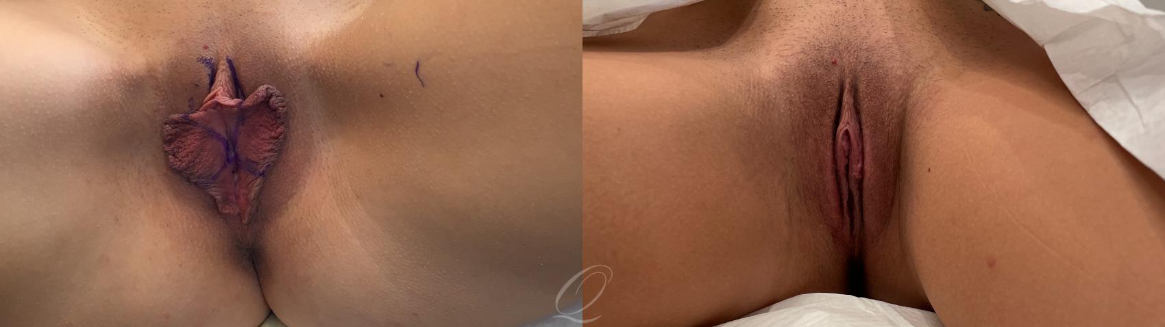 Labiaplasty Case 1001542 Before & After Front | Serving Rochester, Syracuse & Buffalo, NY | Quatela Center for Plastic Surgery