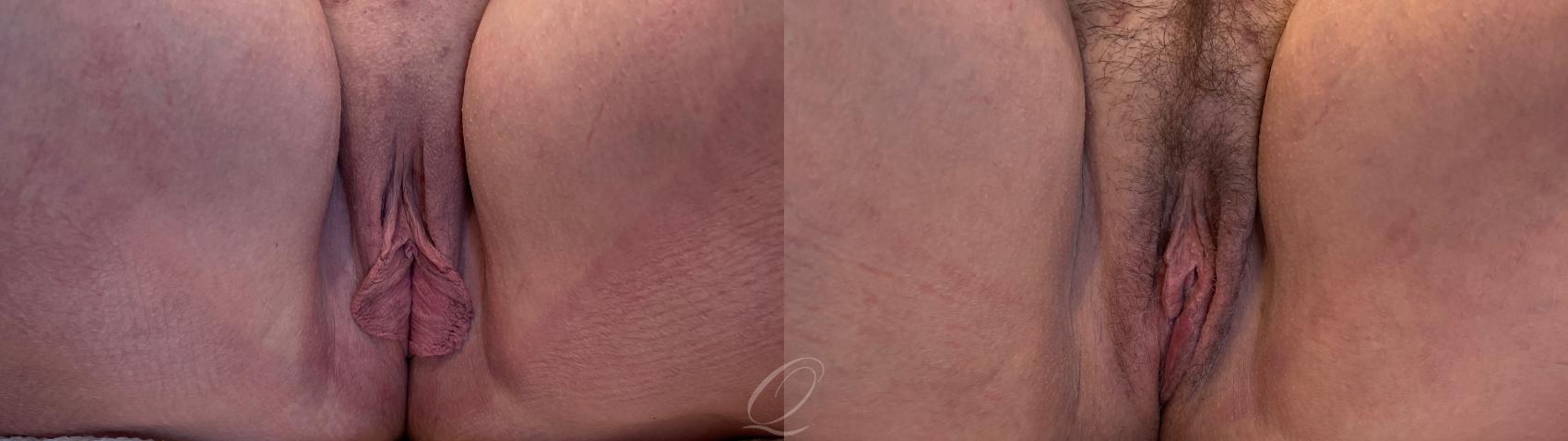 Labiaplasty Case 1001543 Before & After Front | Serving Rochester, Syracuse & Buffalo, NY | Quatela Center for Plastic Surgery